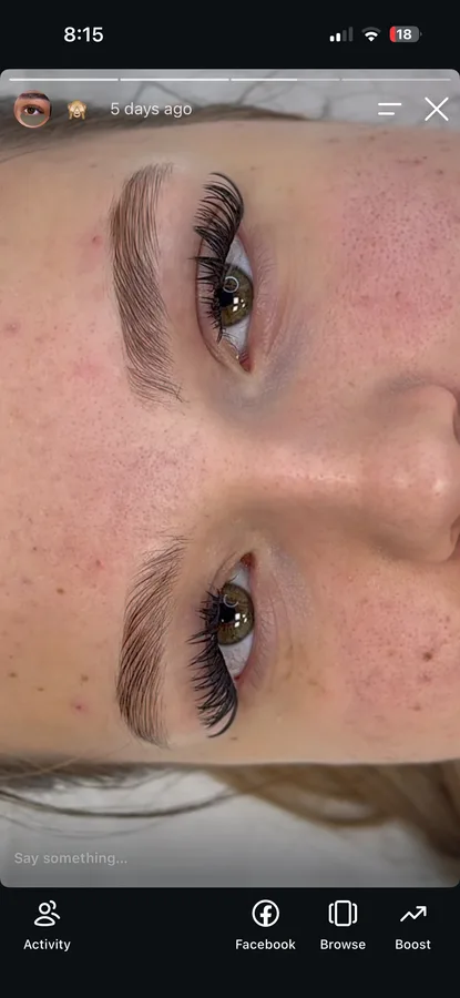 Brow lift